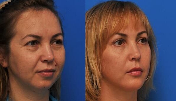 prieš ir po odos atjauninimo su stangrinančia nuotrauka 1