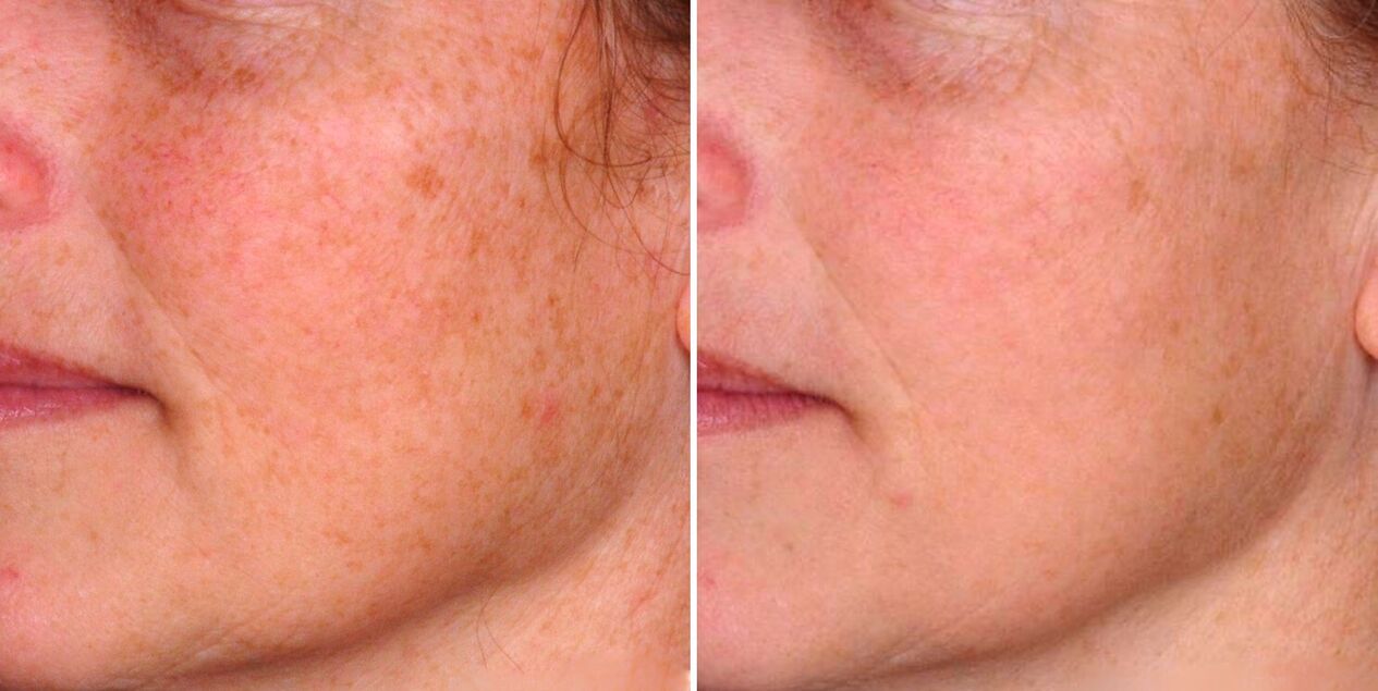 Frakcinės fototermolizės rezultatas – amžiaus dėmių sumažėjimas ant veido odos. 